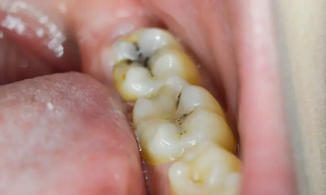 What are the signs of a cavity or tooth decay, and how is it treated?