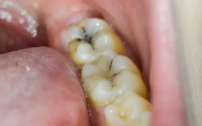 What are the signs of a cavity or tooth decay, and how is it treated?