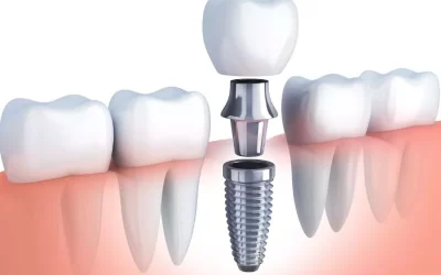 What are dental implants, and who is a good candidate for them?