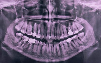 Are dental X-rays safe, and how often should they be taken?