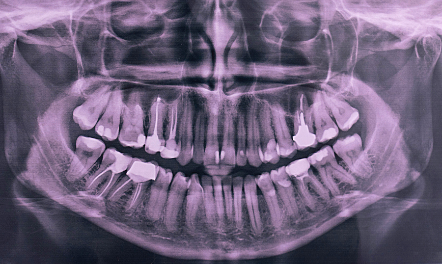 Are dental X-rays safe, and how often should they be taken?